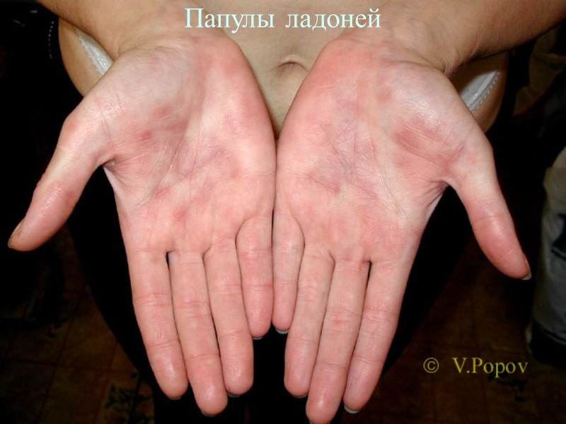 Папулы ладоней